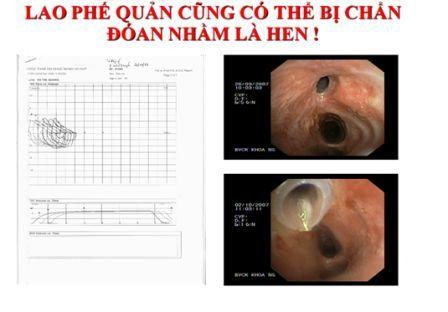 Lao phế qiarn bị chẩn đoán nhầm là hen