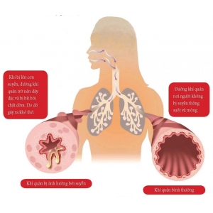 Asthma patients and frequent asked questions