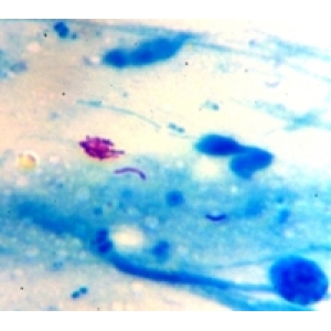Consequence of wrong tuberculosis treatment